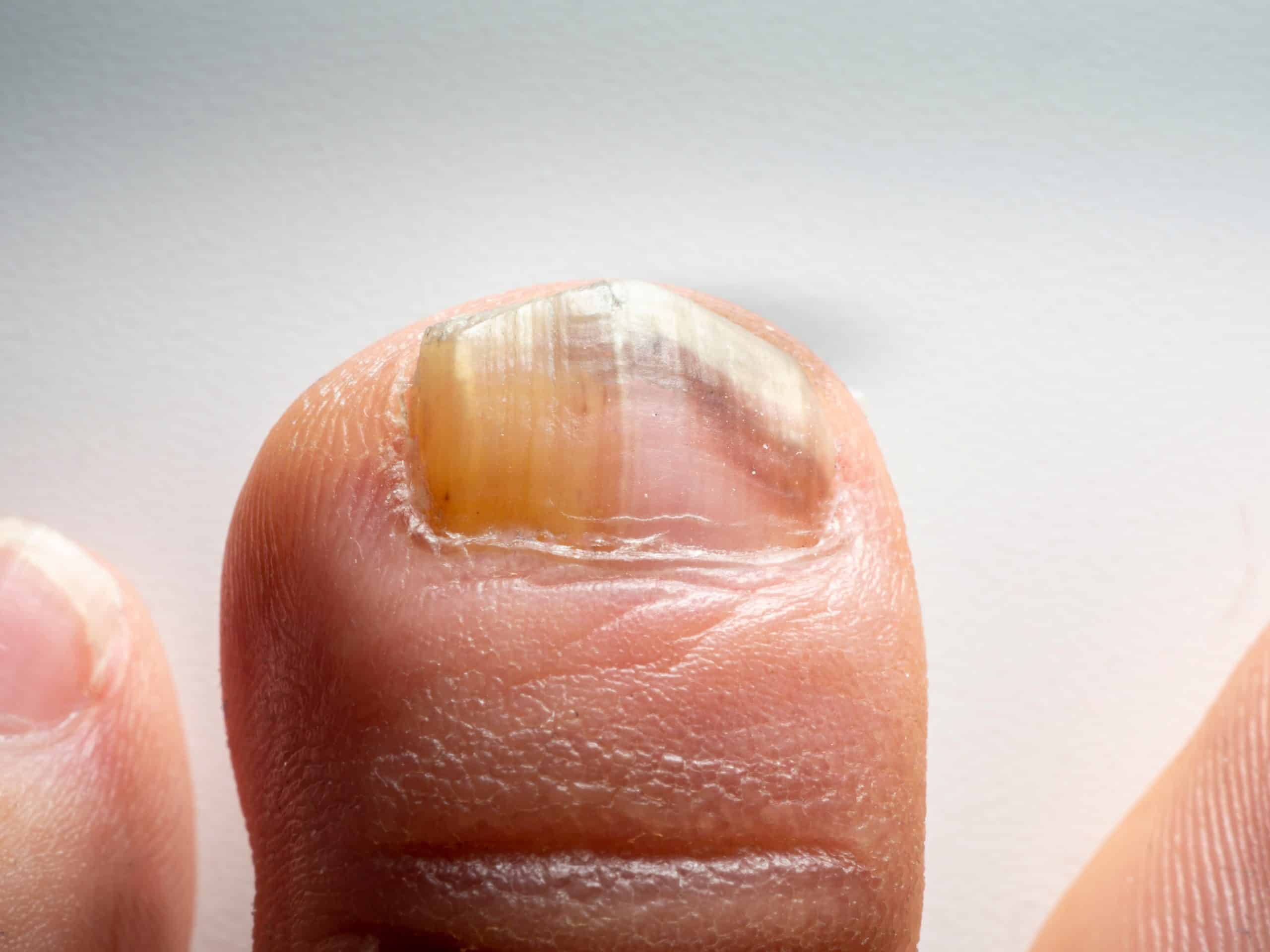 Choroby paznokci – jakie dają objawy?