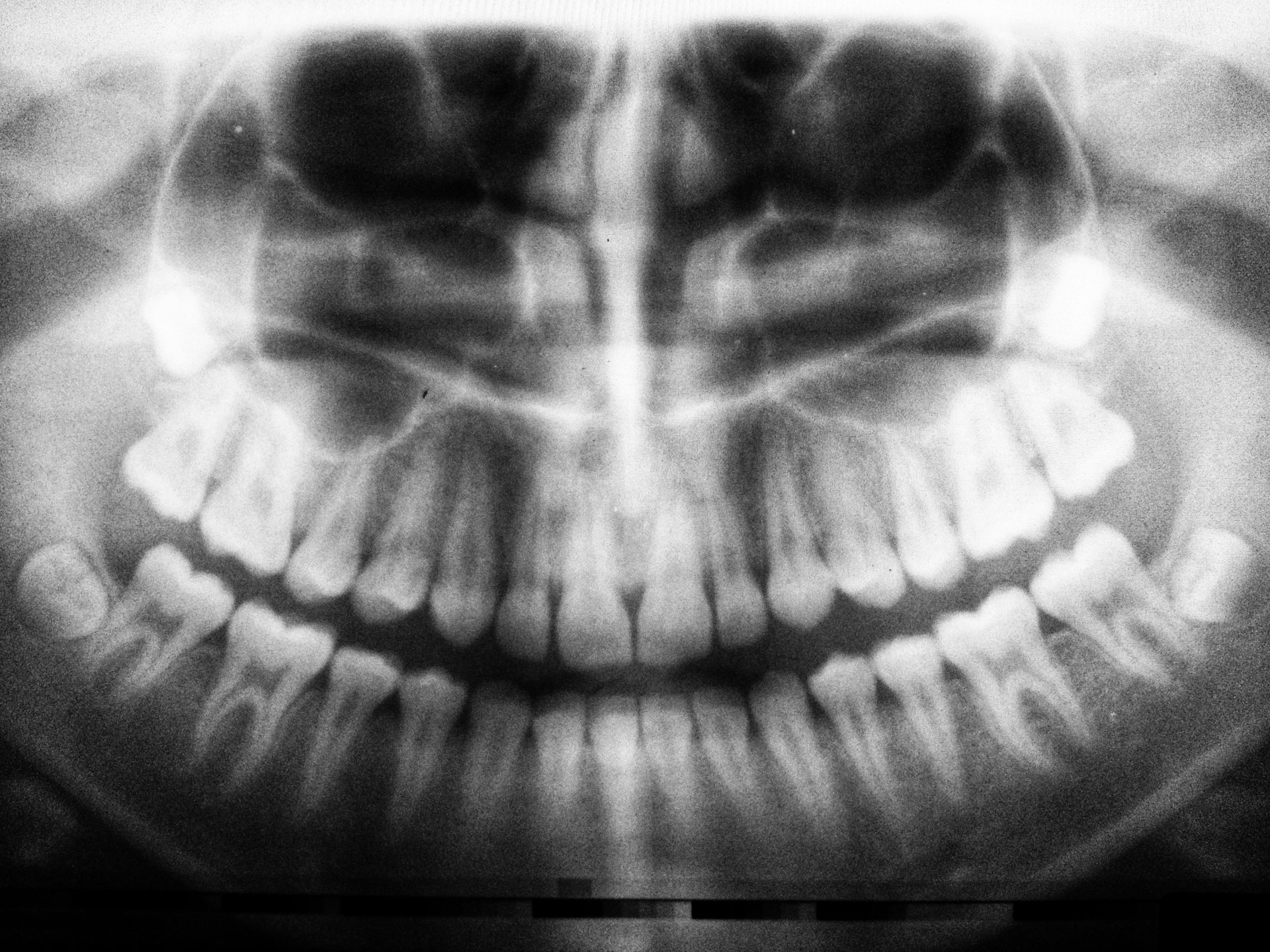 Kiedy i dlaczego warto wykonać tomografię zęba?